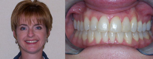 Before & After Braces | Wazio Orthodontics