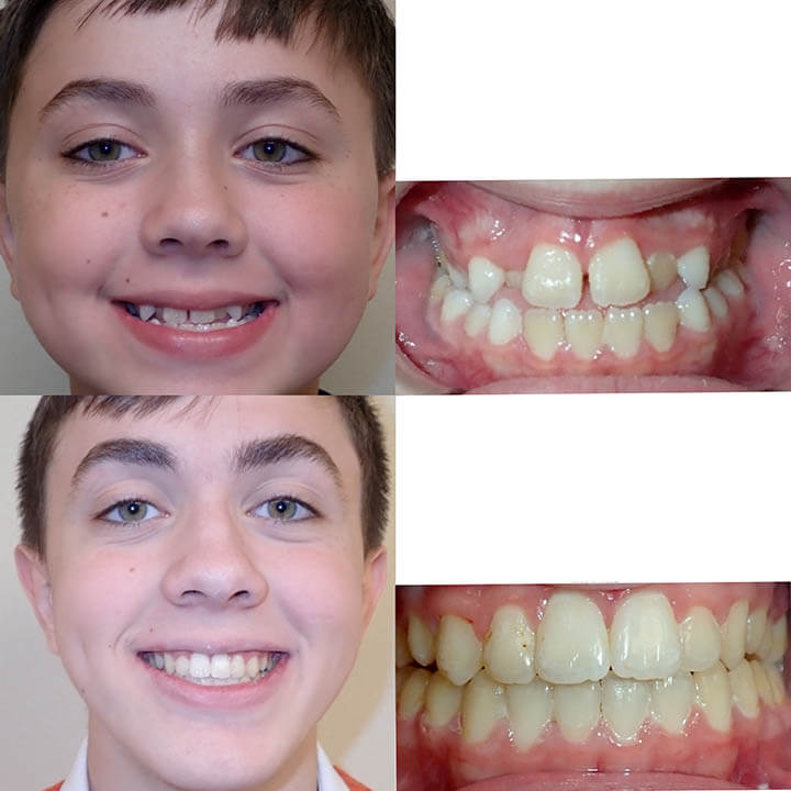 Before After Braces Wazio Orthodontics