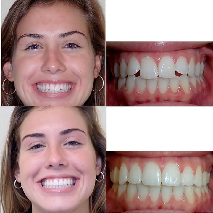 Before & After Invisalign | Wazio Orthodontics