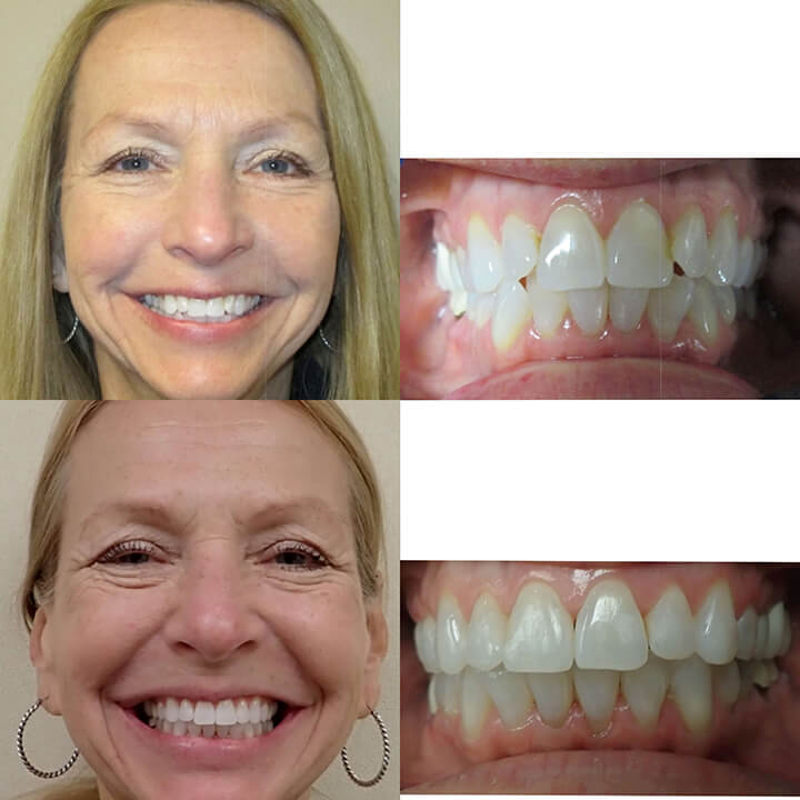 Before & After Invisalign Wazio Orthodontics