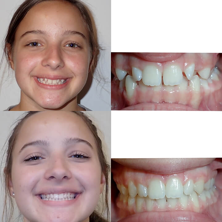 invisalign before and after spacing