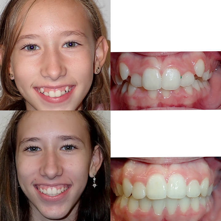 Before & After Braces