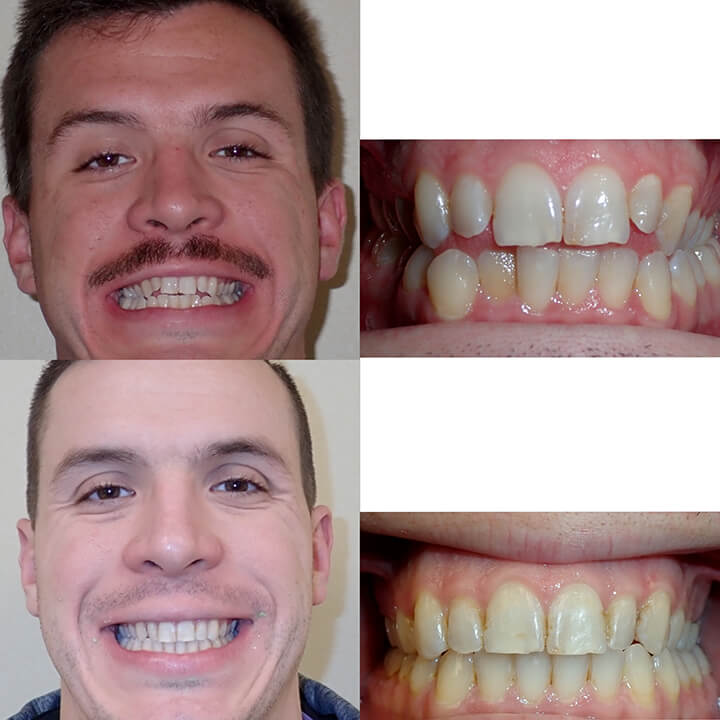 braces adult before and after