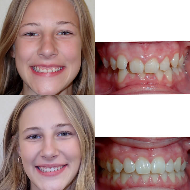 Before & After Invisalign