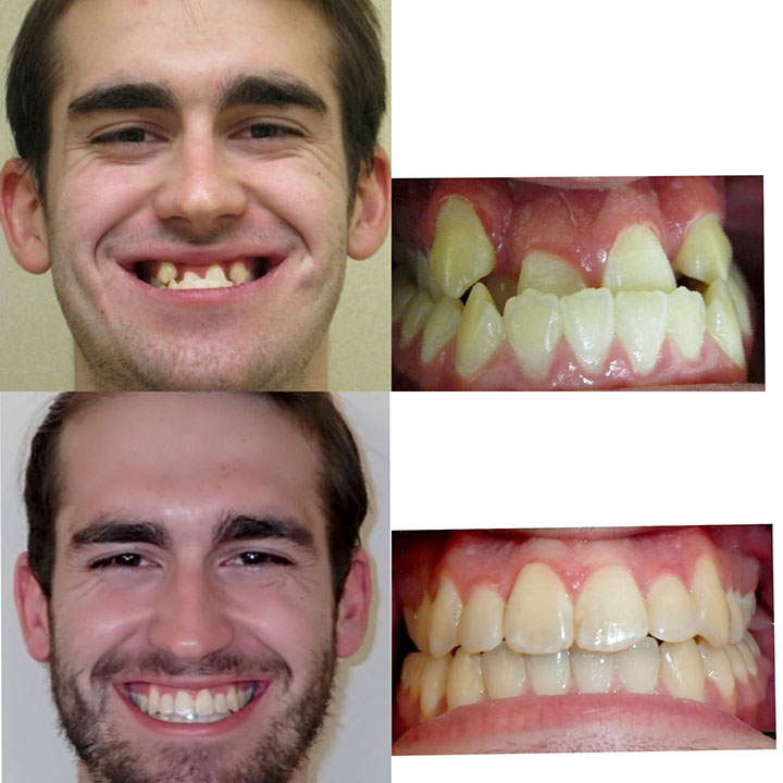 Orthodontist Braces Before And After