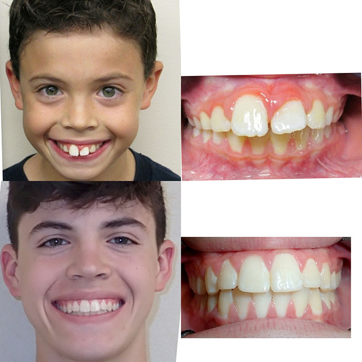 teeth brace before and after