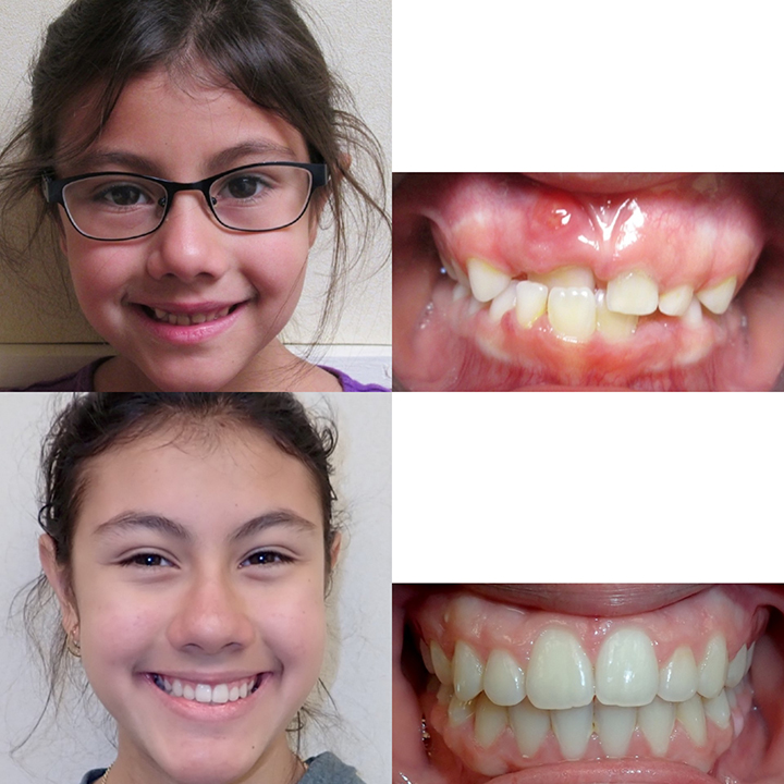Orthodontic Before and After Photos